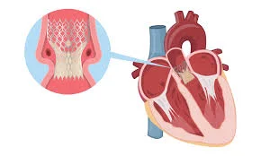Transcatheter aortic valve replacement