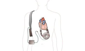 Ventricular assist device