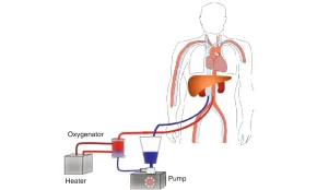 Normothermic regional perfusion